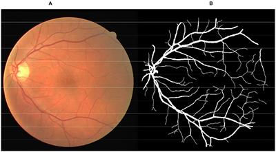 Retinal Vessel Segmentation Based on B-COSFIRE Filters in Fundus Images